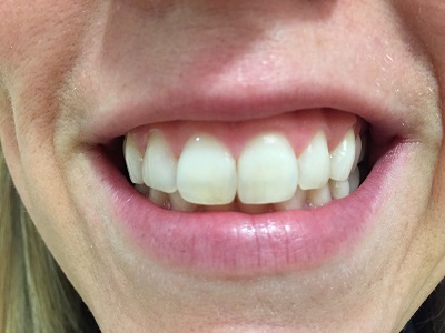 Photo of teeth by selfie